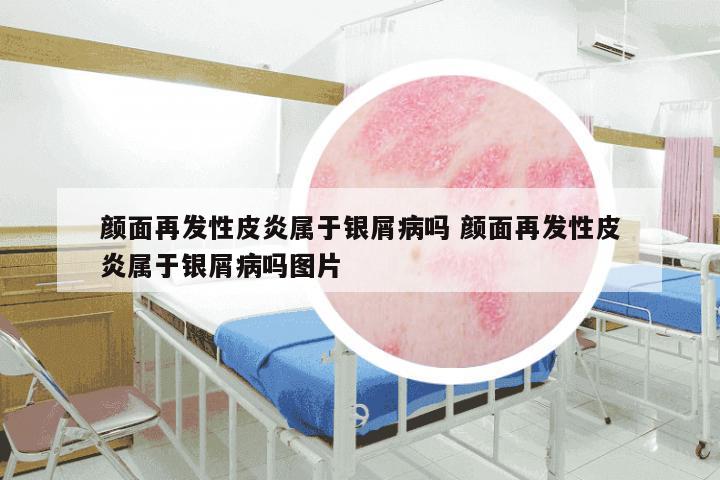 颜面再发性皮炎属于银屑病吗 颜面再发性皮炎属于银屑病吗图片