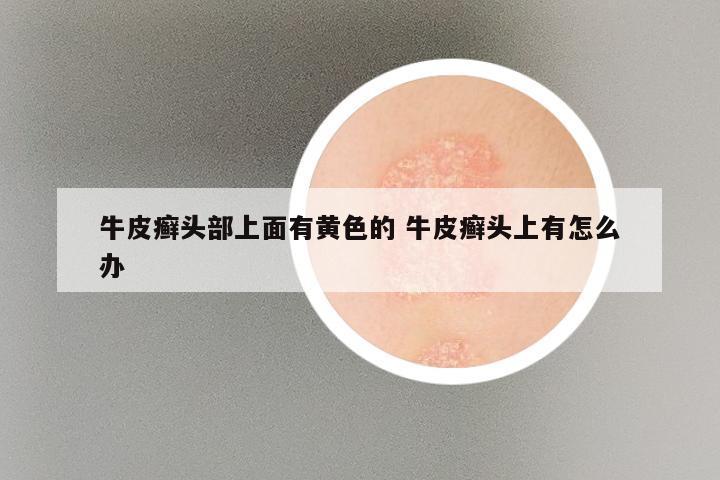 牛皮癣头部上面有黄色的 牛皮癣头上有怎么办