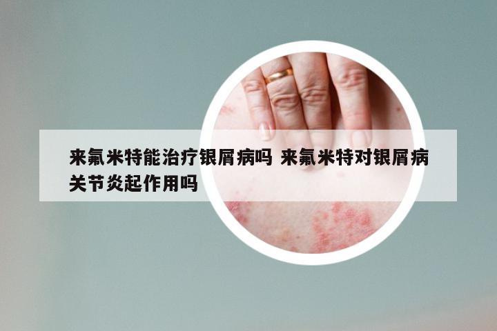 来氟米特能治疗银屑病吗 来氟米特对银屑病关节炎起作用吗