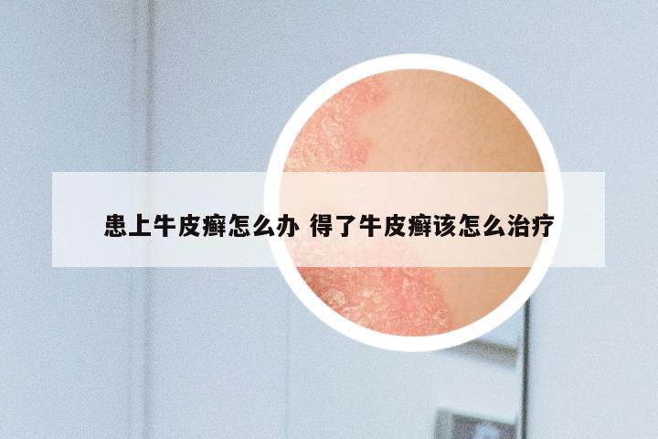 患上牛皮癣怎么办 得了牛皮癣该怎么治疗