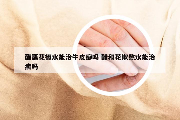 醋蘸花椒水能治牛皮癣吗 醋和花椒熬水能治癣吗