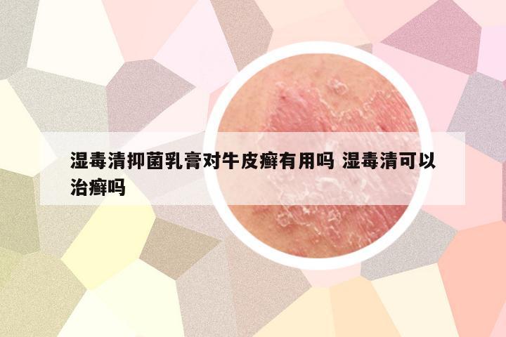 湿毒清抑菌乳膏对牛皮癣有用吗 湿毒清可以治癣吗