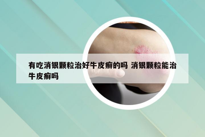 有吃消银颗粒治好牛皮癣的吗 消银颗粒能治牛皮癣吗