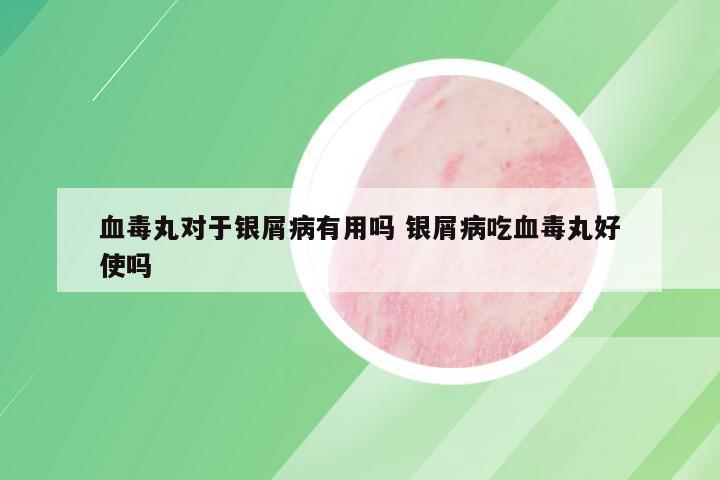 血毒丸对于银屑病有用吗 银屑病吃血毒丸好使吗