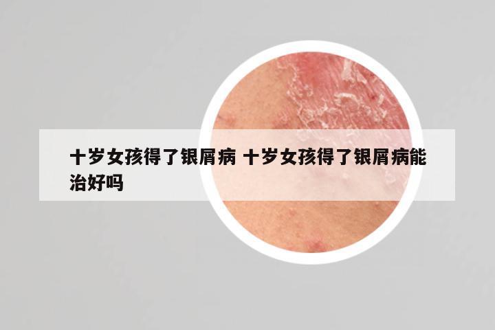 十岁女孩得了银屑病 十岁女孩得了银屑病能治好吗