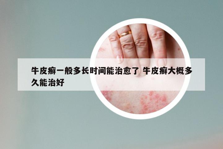 牛皮癣一般多长时间能治愈了 牛皮癣大概多久能治好