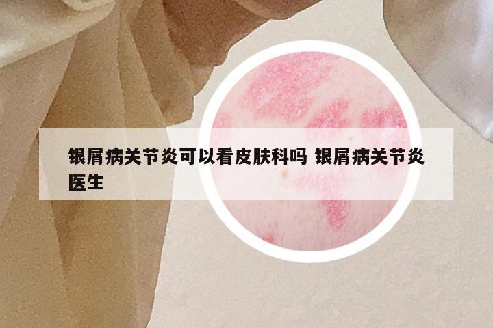 银屑病关节炎可以看皮肤科吗 银屑病关节炎医生