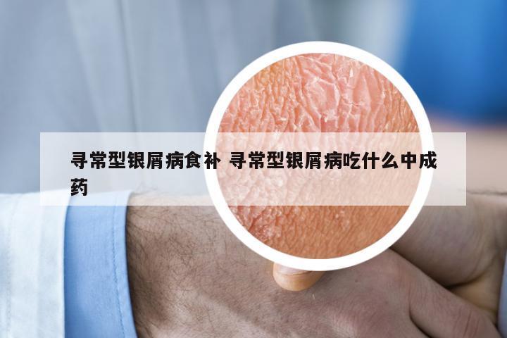 寻常型银屑病食补 寻常型银屑病吃什么中成药
