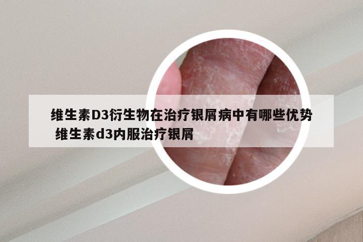 维生素D3衍生物在治疗银屑病中有哪些优势 维生素d3内服治疗银屑