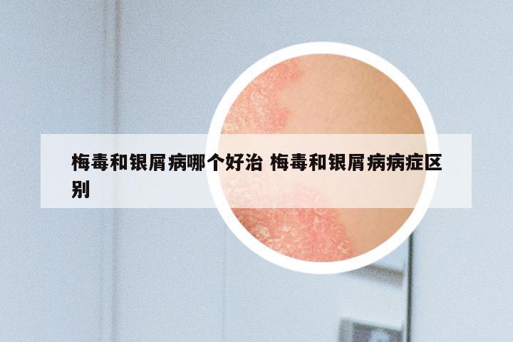 梅毒和银屑病哪个好治 梅毒和银屑病病症区别