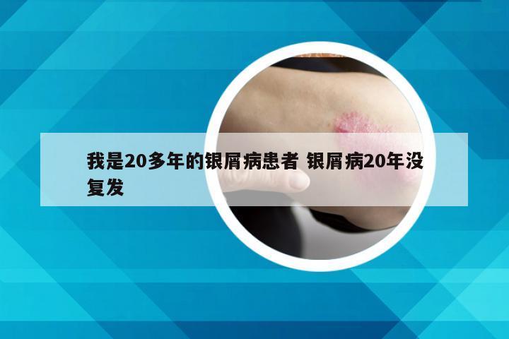 我是20多年的银屑病患者 银屑病20年没复发