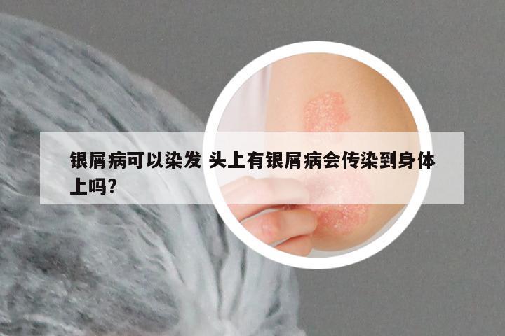 银屑病可以染发 头上有银屑病会传染到身体上吗?