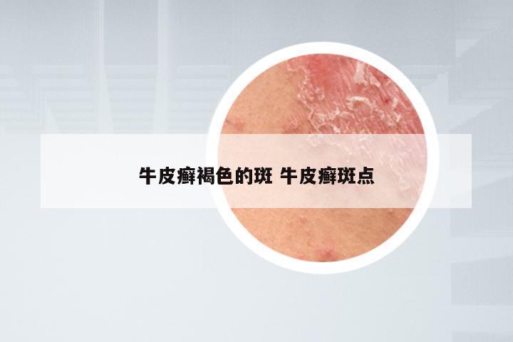牛皮癣褐色的斑 牛皮癣斑点