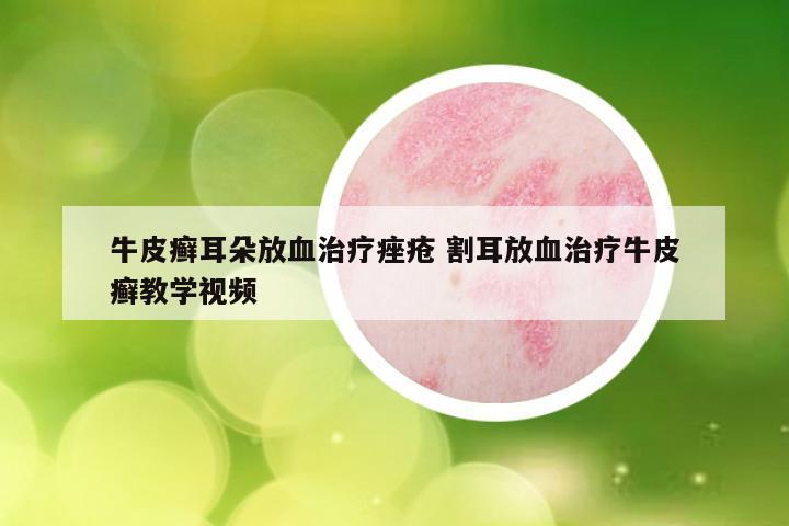 牛皮癣耳朵放血治疗痤疮 割耳放血治疗牛皮癣教学视频