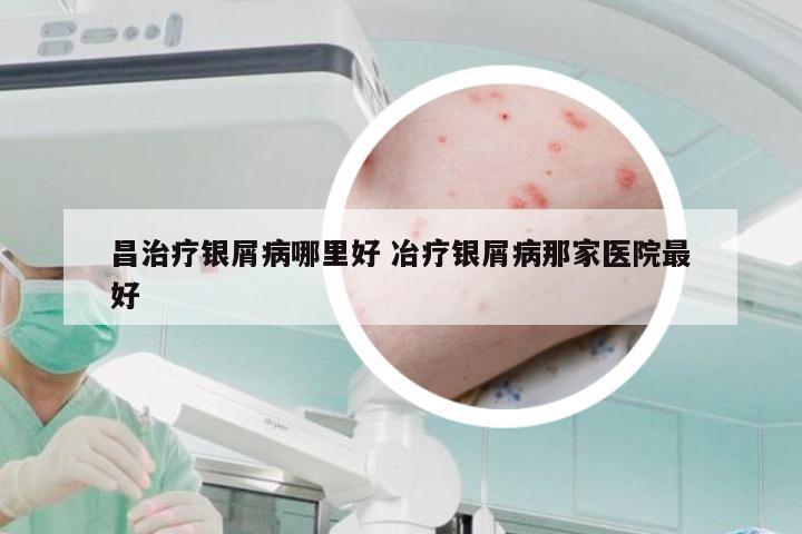 昌治疗银屑病哪里好 冶疗银屑病那家医院最好