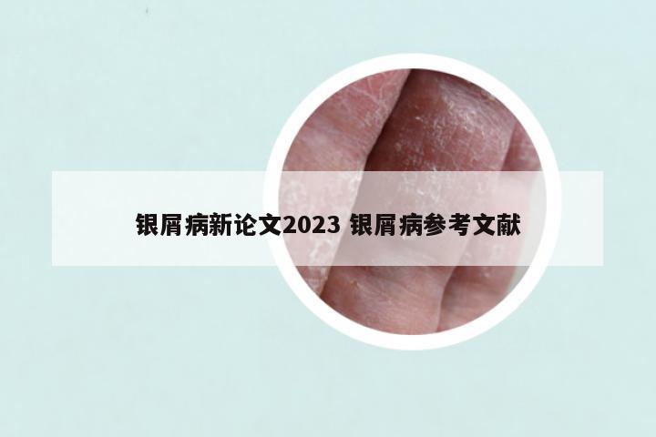银屑病新论文2023 银屑病参考文献
