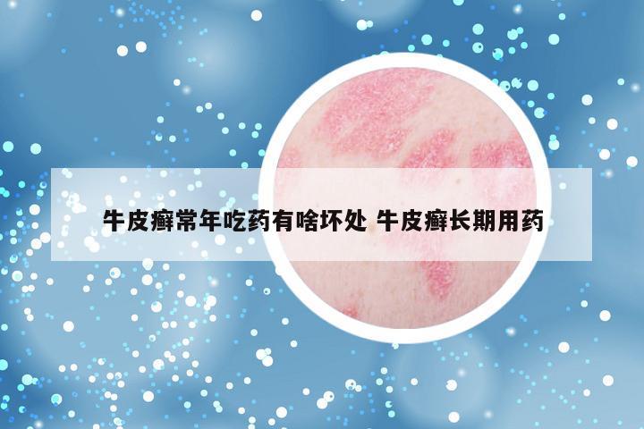 牛皮癣常年吃药有啥坏处 牛皮癣长期用药