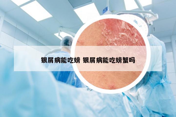 银屑病能吃螃 银屑病能吃螃蟹吗