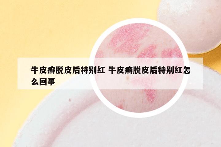 牛皮癣脱皮后特别红 牛皮癣脱皮后特别红怎么回事