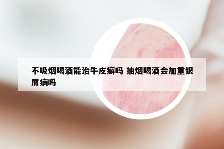 不吸烟喝酒能治牛皮癣吗 抽烟喝酒会加重银屑病吗