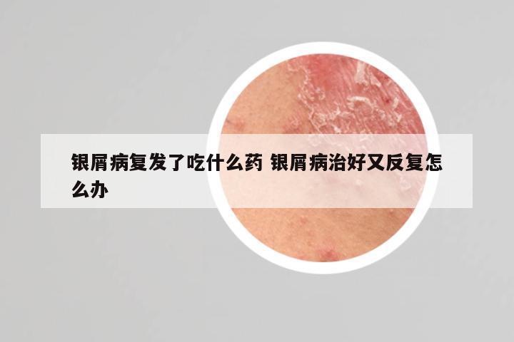 银屑病复发了吃什么药 银屑病治好又反复怎么办