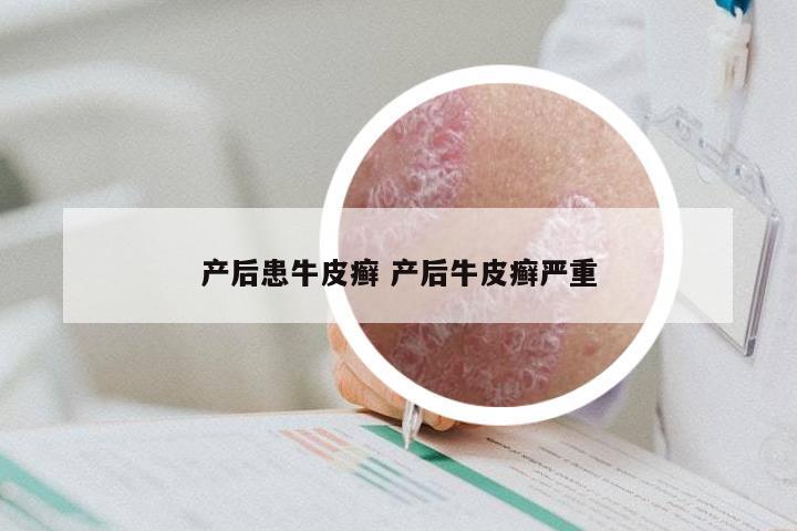 产后患牛皮癣 产后牛皮癣严重