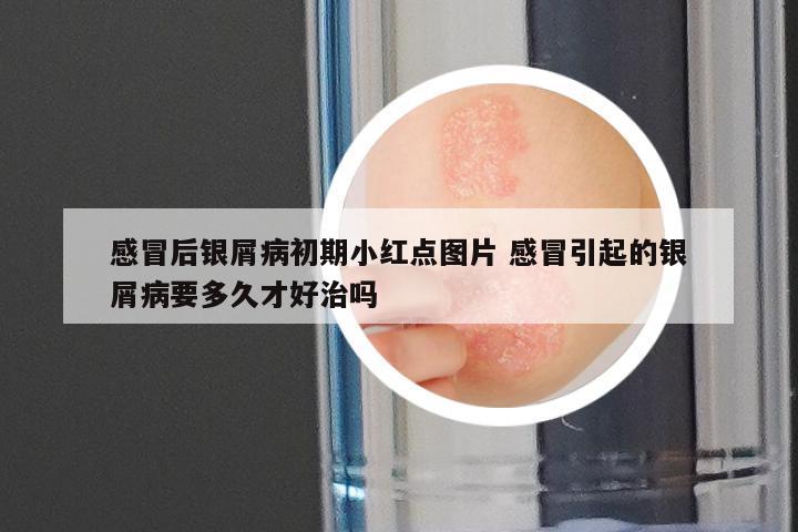 感冒后银屑病初期小红点图片 感冒引起的银屑病要多久才好治吗