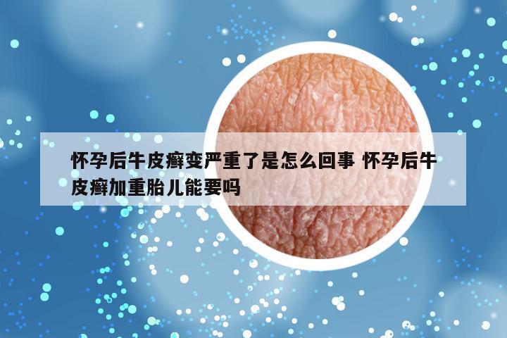 怀孕后牛皮癣变严重了是怎么回事 怀孕后牛皮癣加重胎儿能要吗