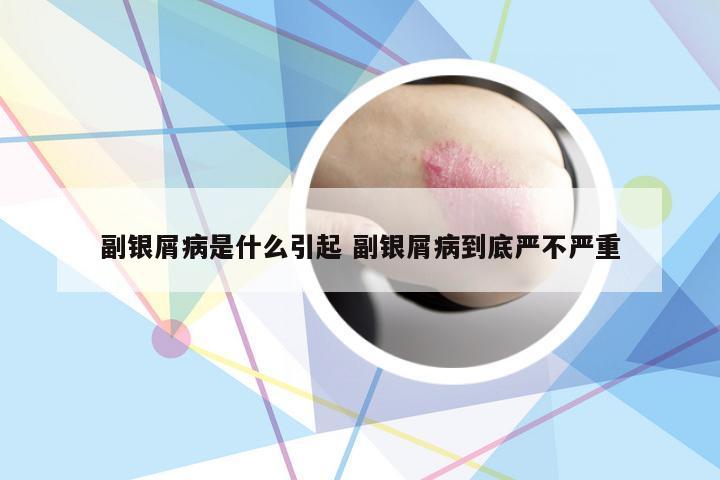 副银屑病是什么引起 副银屑病到底严不严重