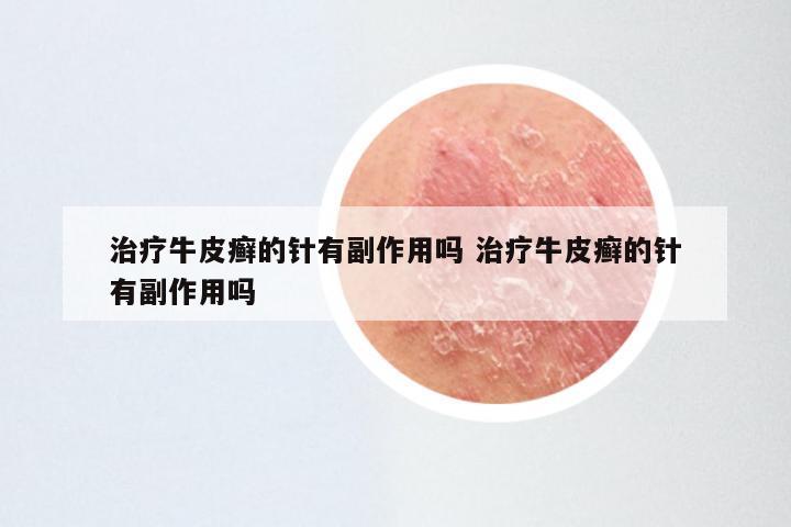 治疗牛皮癣的针有副作用吗 治疗牛皮癣的针有副作用吗