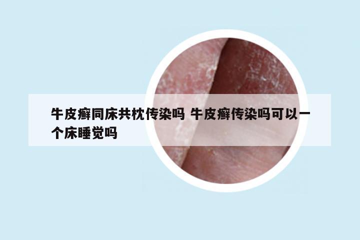 牛皮癣同床共枕传染吗 牛皮癣传染吗可以一个床睡觉吗