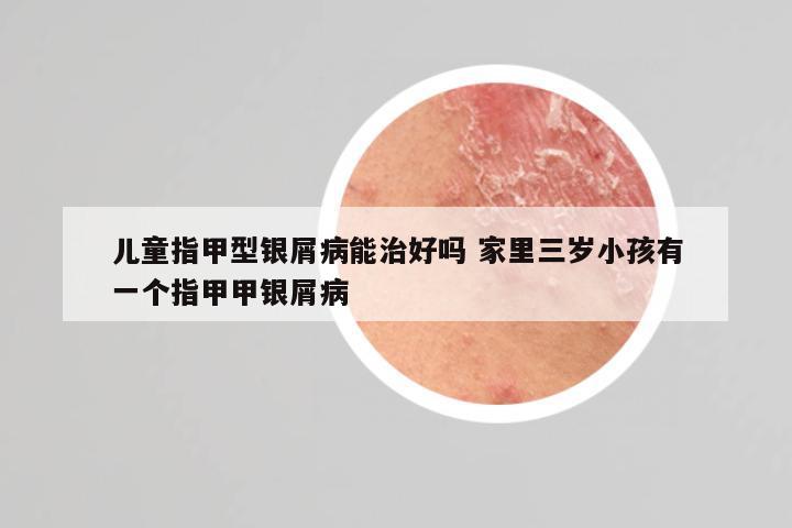 儿童指甲型银屑病能治好吗 家里三岁小孩有一个指甲甲银屑病