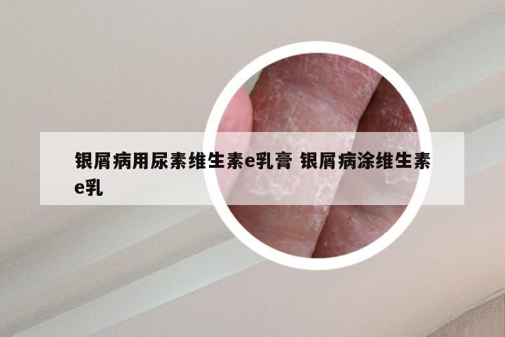 银屑病用尿素维生素e乳膏 银屑病涂维生素e乳