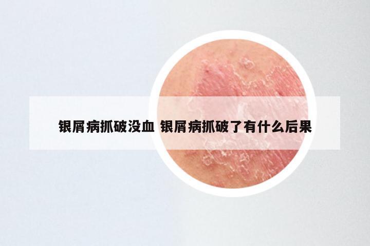 银屑病抓破没血 银屑病抓破了有什么后果