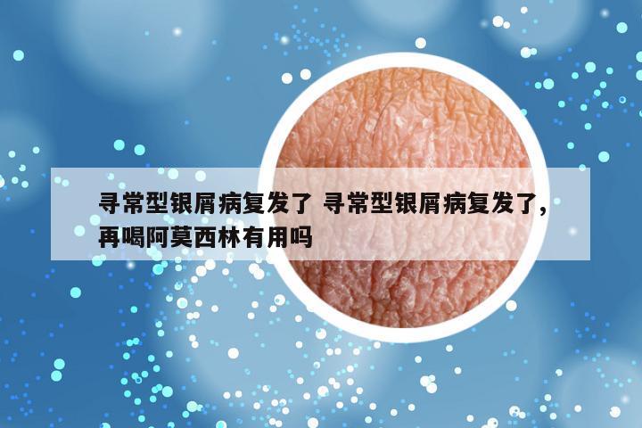 寻常型银屑病复发了 寻常型银屑病复发了,再喝阿莫西林有用吗