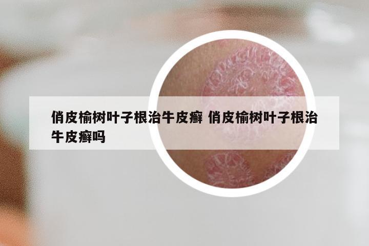 俏皮榆树叶子根治牛皮癣 俏皮榆树叶子根治牛皮癣吗