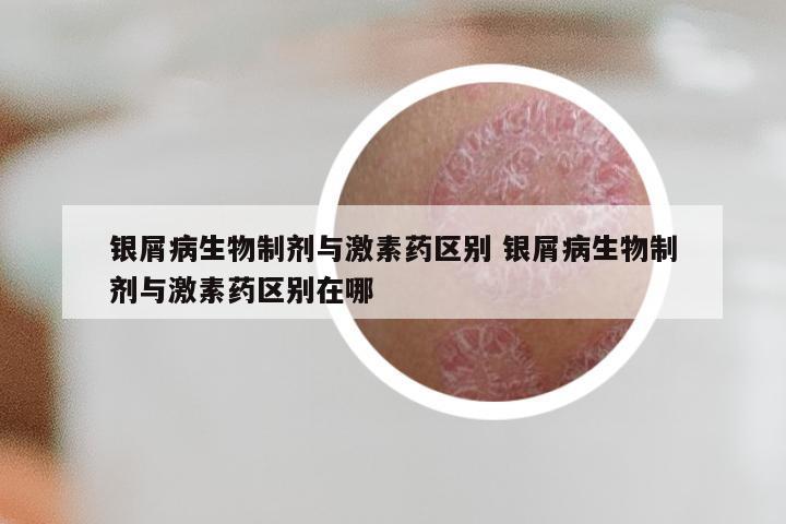 银屑病生物制剂与激素药区别 银屑病生物制剂与激素药区别在哪