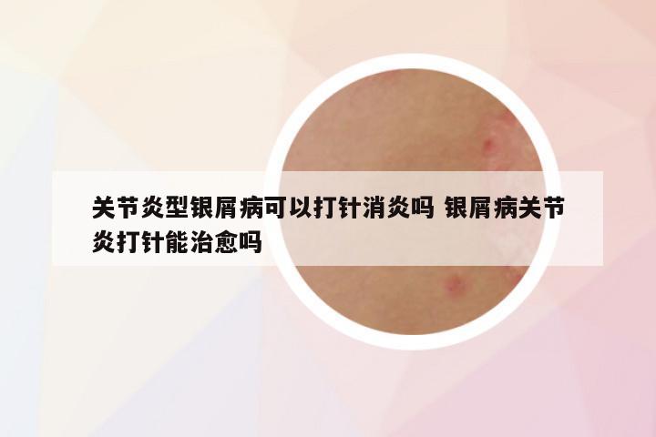 关节炎型银屑病可以打针消炎吗 银屑病关节炎打针能治愈吗