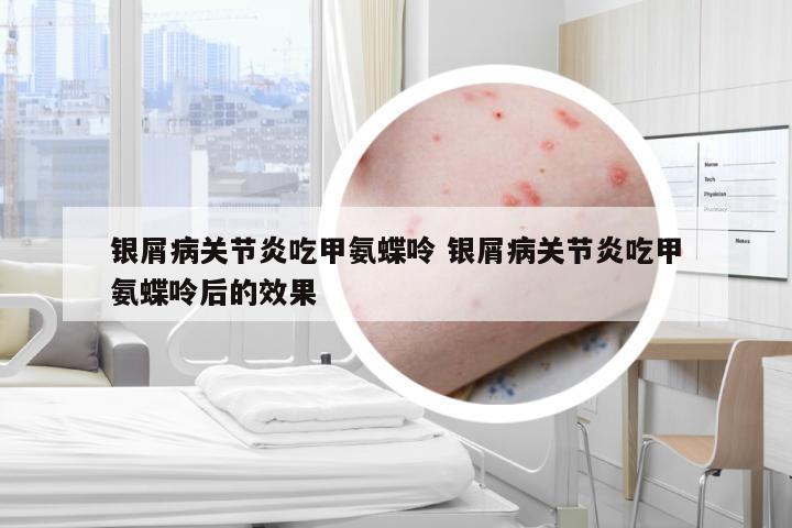 银屑病关节炎吃甲氨蝶呤 银屑病关节炎吃甲氨蝶呤后的效果