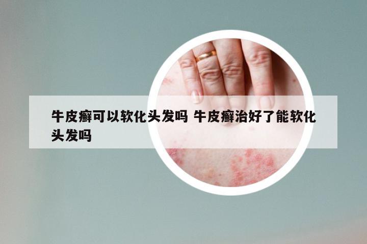 牛皮癣可以软化头发吗 牛皮癣治好了能软化头发吗