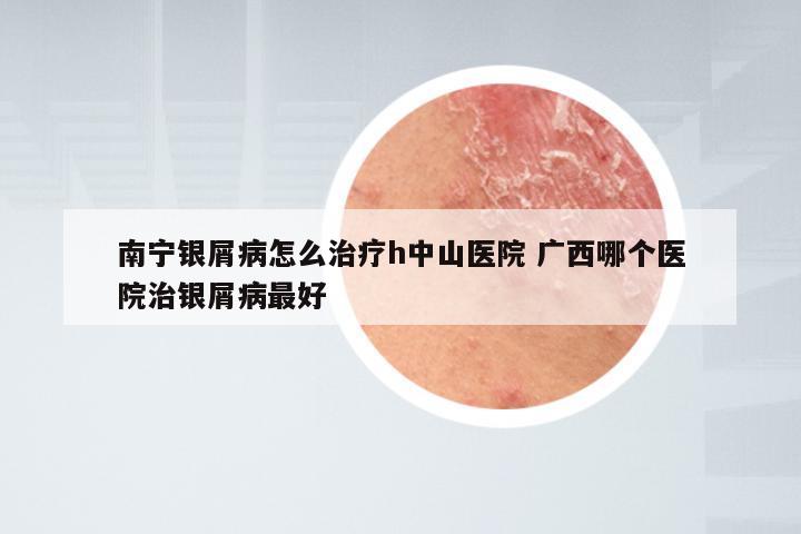 南宁银屑病怎么治疗h中山医院 广西哪个医院治银屑病最好