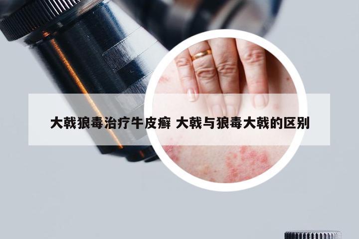 大戟狼毒治疗牛皮癣 大戟与狼毒大戟的区别
