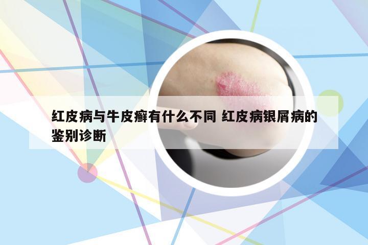 红皮病与牛皮癣有什么不同 红皮病银屑病的鉴别诊断