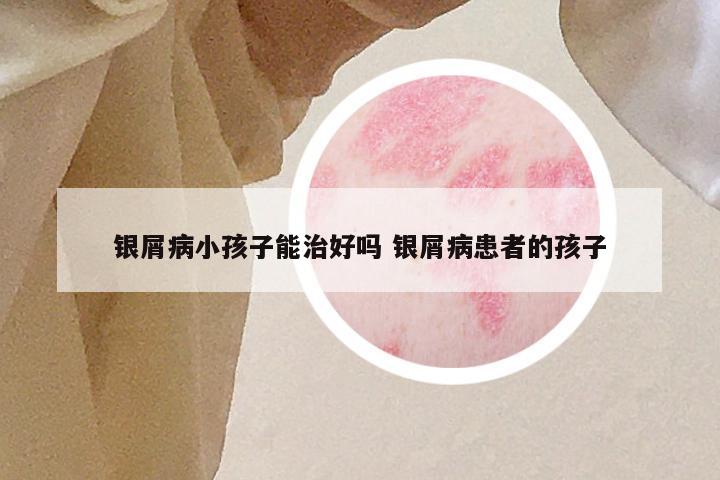 银屑病小孩子能治好吗 银屑病患者的孩子