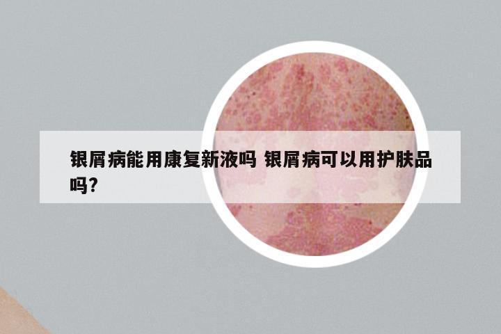 银屑病能用康复新液吗 银屑病可以用护肤品吗?