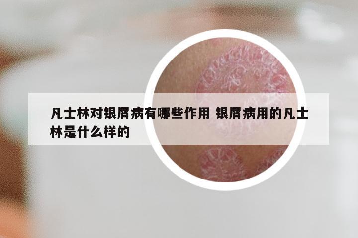 凡士林对银屑病有哪些作用 银屑病用的凡士林是什么样的