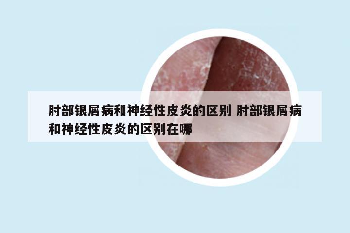 肘部银屑病和神经性皮炎的区别 肘部银屑病和神经性皮炎的区别在哪