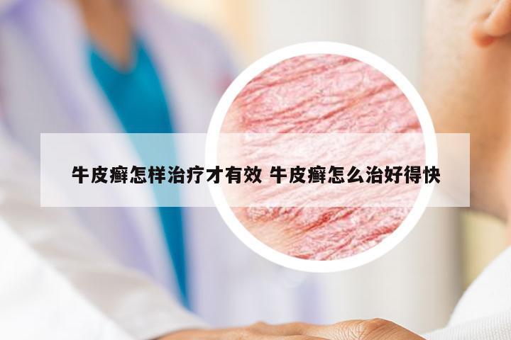 牛皮癣怎样治疗才有效 牛皮癣怎么治好得快