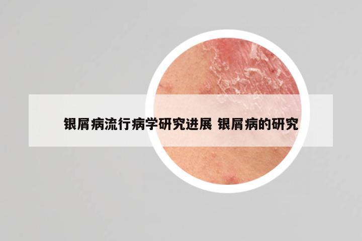 银屑病流行病学研究进展 银屑病的研究