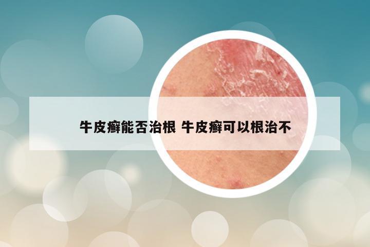 牛皮癣能否治根 牛皮癣可以根治不